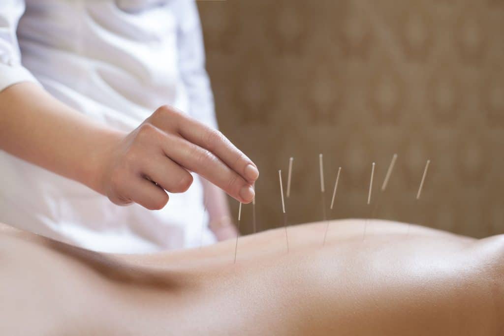 acupuncture