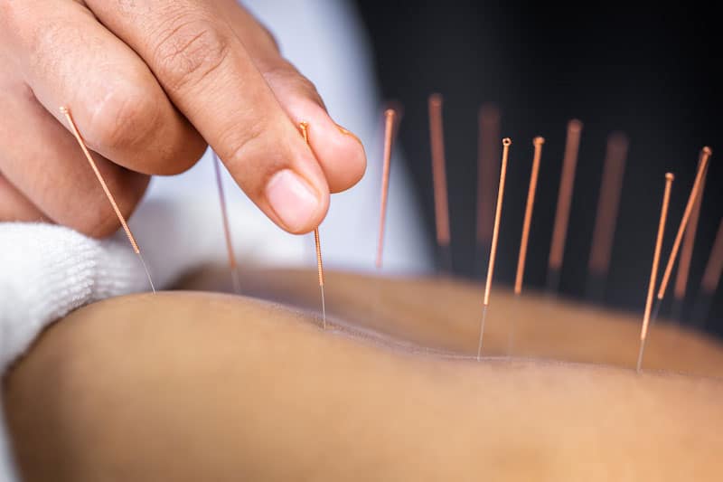 acupuncture 3